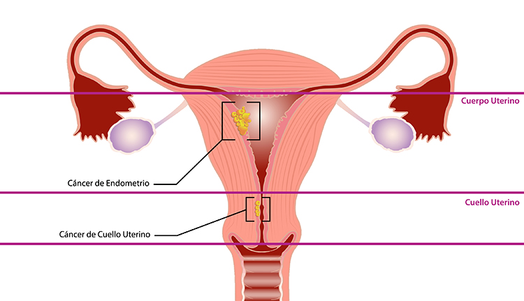 cancer de utero
