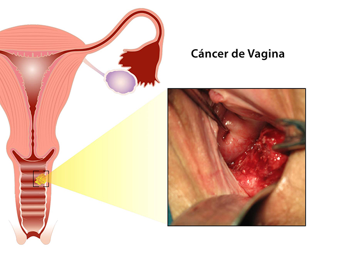 cancer vagina
